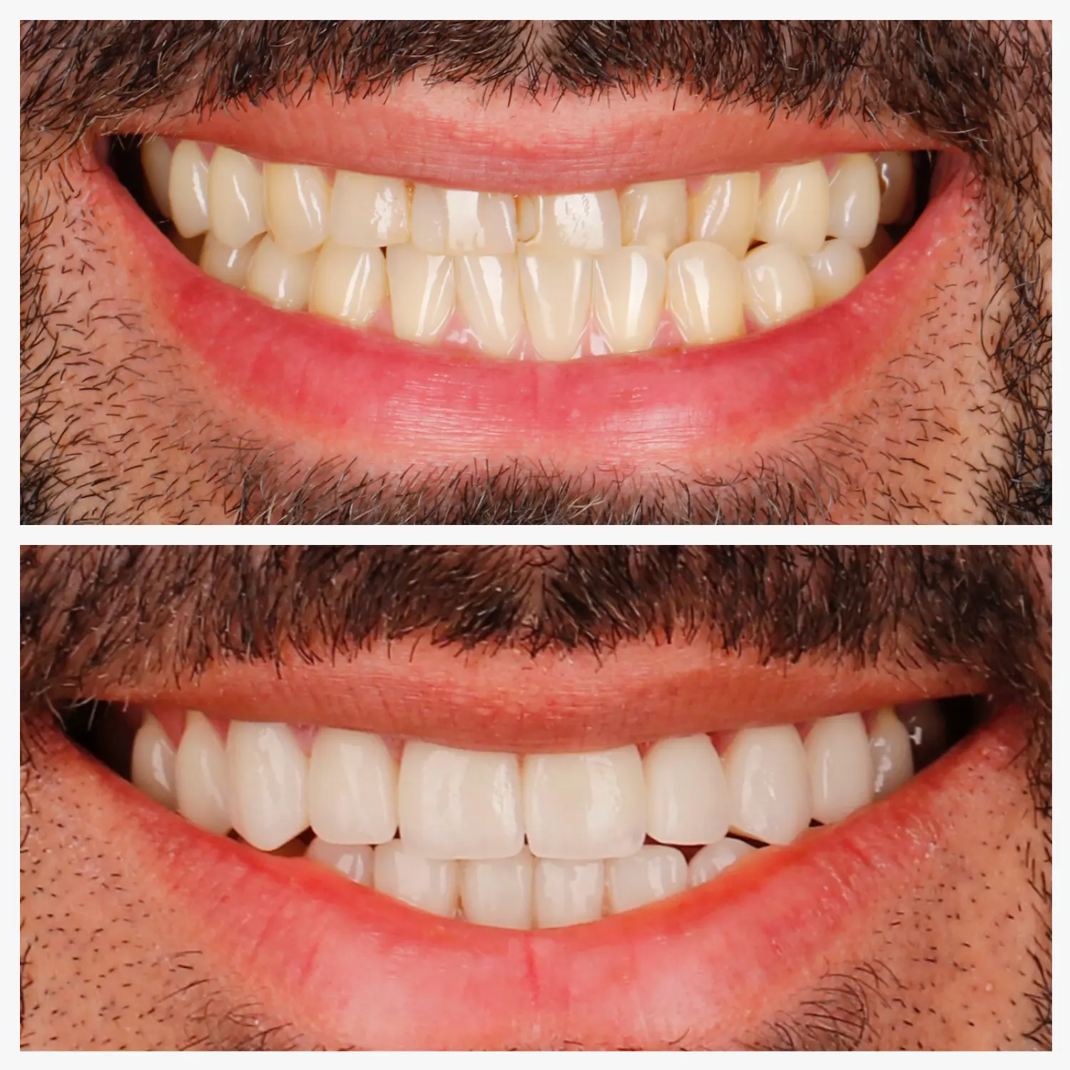 Zahnästhetik mit Veneers im Vergleich