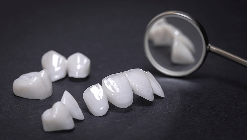 Non-Prep Veneers für Zähne