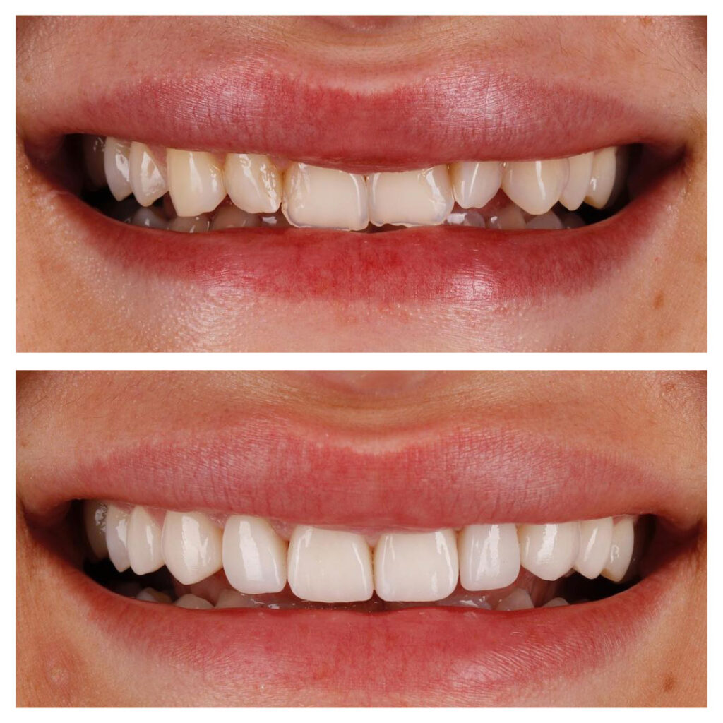 Veneers VorherNachher Bilder Makellose & natürliche Zähne
