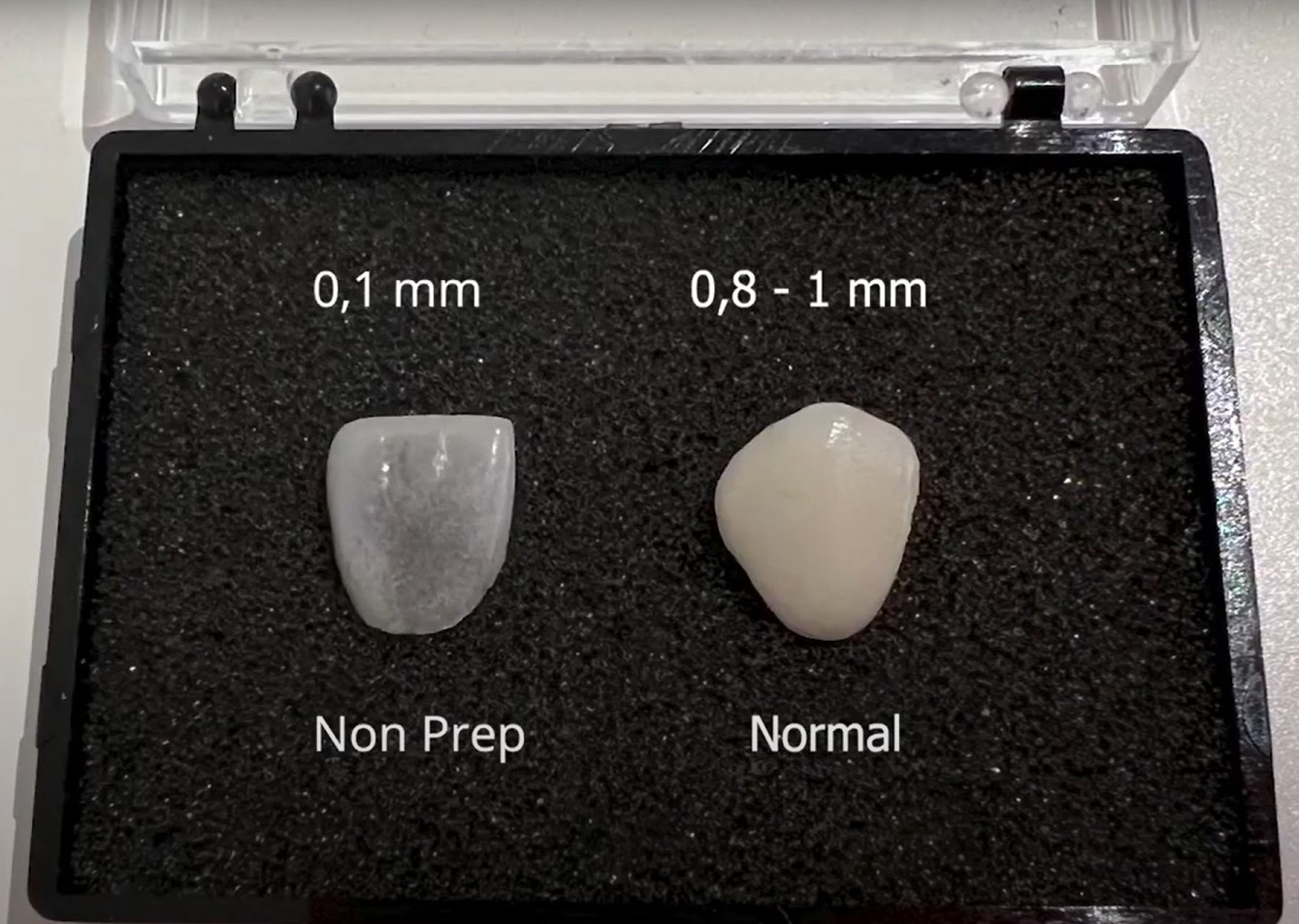 NonPrep Veneers by innoEsthetics